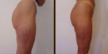 Before and After Treatment 4