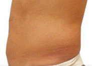 DESPUÉS (4 SESIONES)