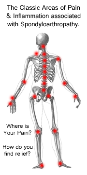 Classic Pain Location of Ankylosing Spondylitis.  Print your free daily pain log, click here!