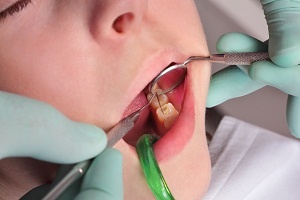 symptoms of a cavity - dentist examining tooth using tool