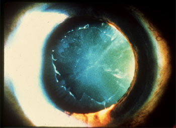 Pseudoexfoliation Glaucoma 