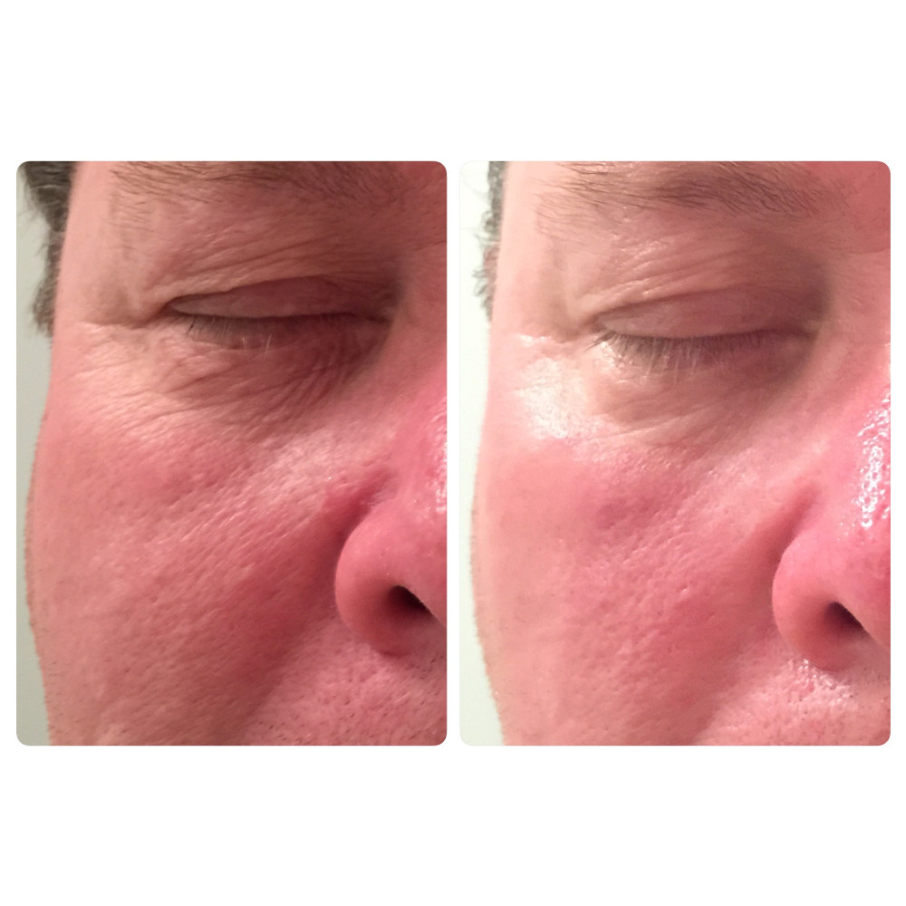 Before and after 4 treatments