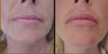 Before and After Treatment 1