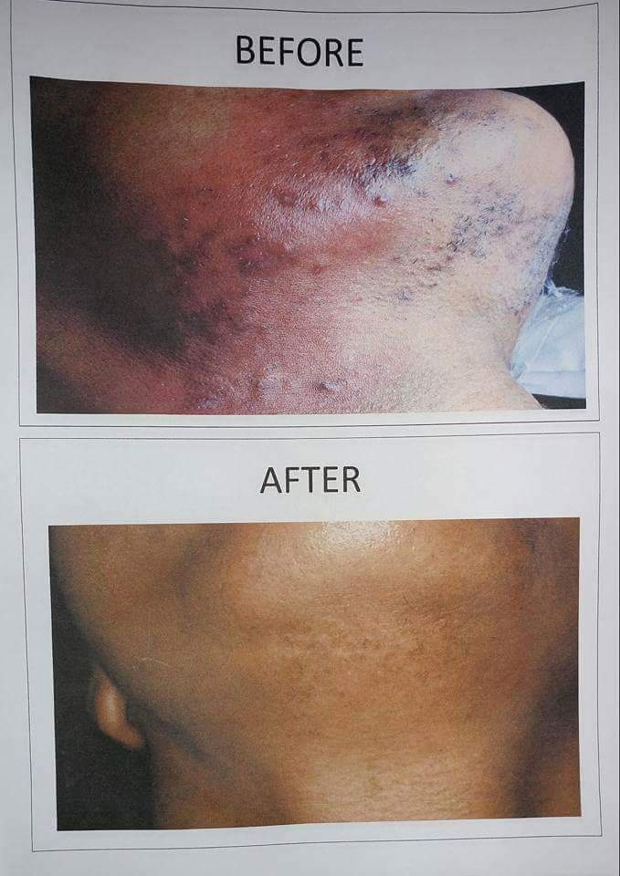 lectrology Treatment (Before and After)