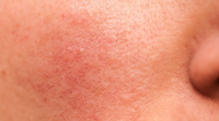 Dermatología Integral "Medica Grijalva"  - TRATAMIENTOS CONTRA ALERGIAS