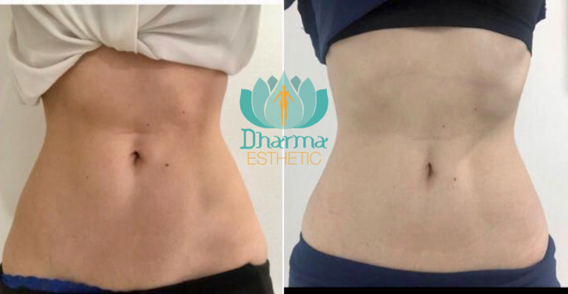 Reduce abdomen Deep Slim