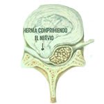 Hernia Discal por laser
