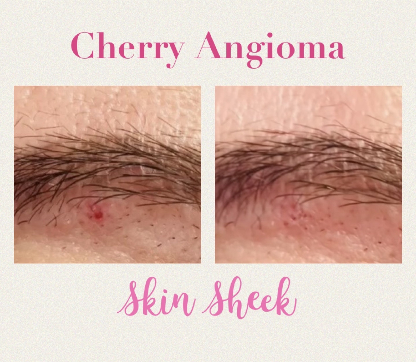 CHERRY ANGIOMA