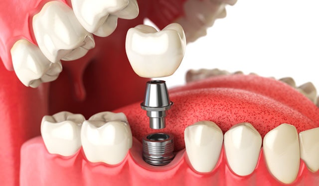 Vimarz Soluciones Dentales  - PROTESIS DENTALES