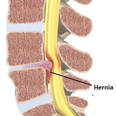 https://0201.nccdn.net/1_2/000/000/0cf/0ec/hernia-discal1.jpg