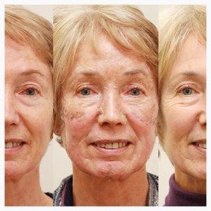 Anti-Aging Peel