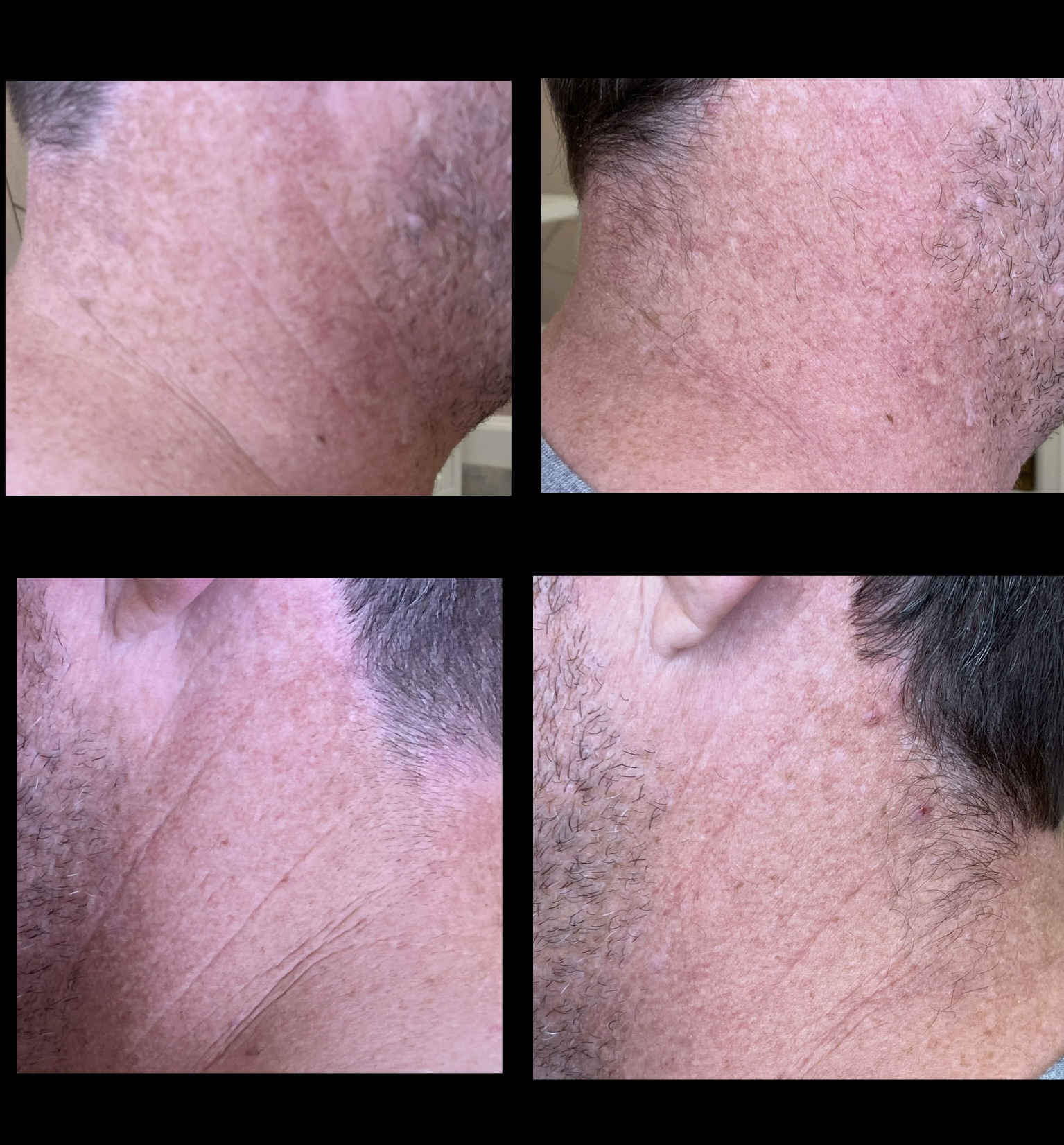 Golfers Neck - complete neck rejuvenation