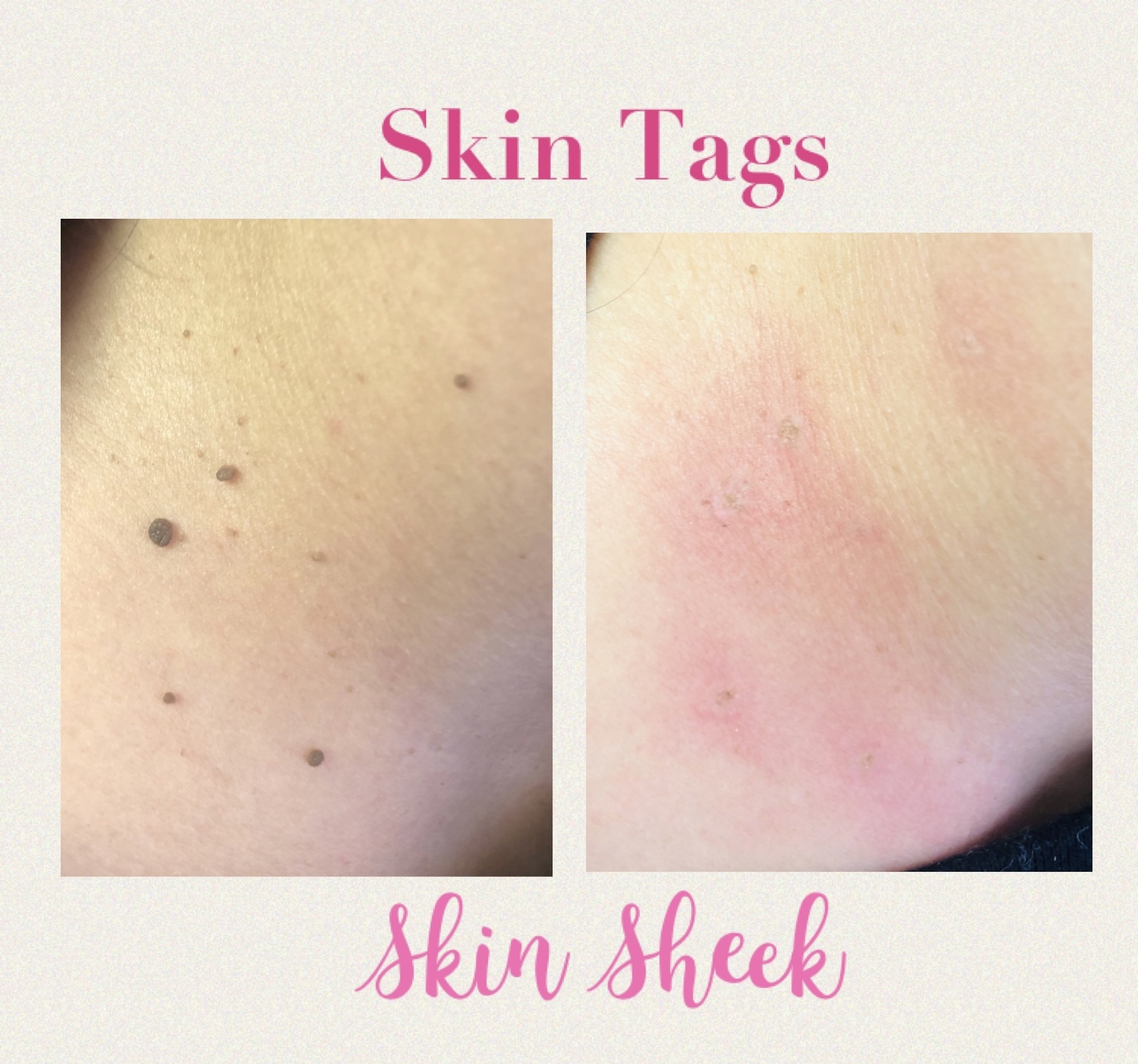 SKIN TAG REMOVAL
