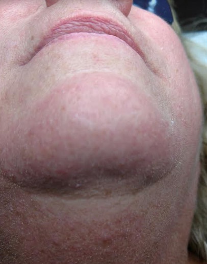 Chin Hair Removal Treatment (After)
