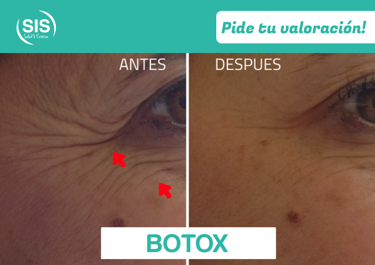 https://0201.nccdn.net/1_2/000/000/0d9/f2a/BOTOX2-1200x849.jpg