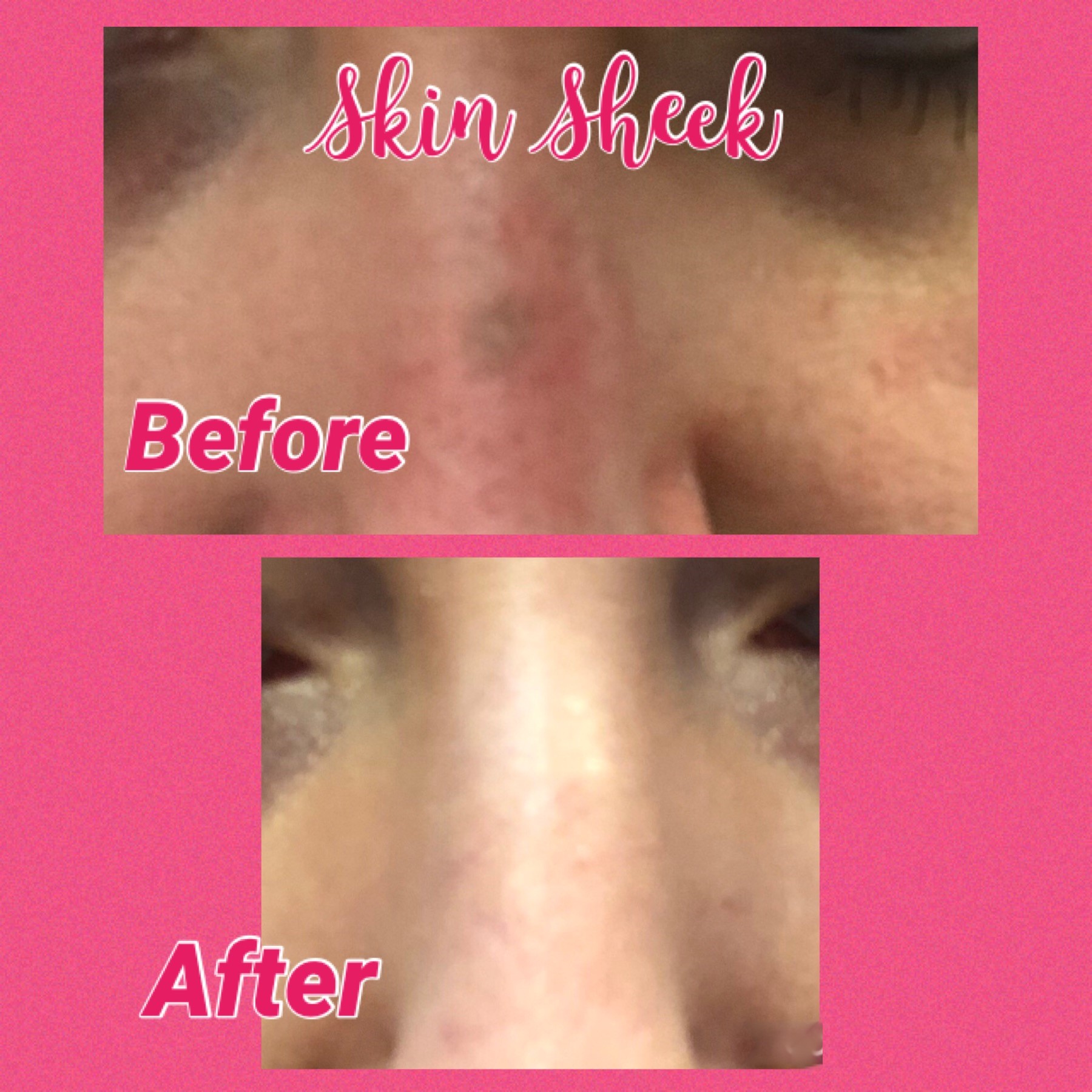 SUN SPOT ON NOSE BRIDGE-post 2 weeks