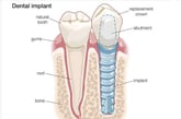 Dental implant technique||||