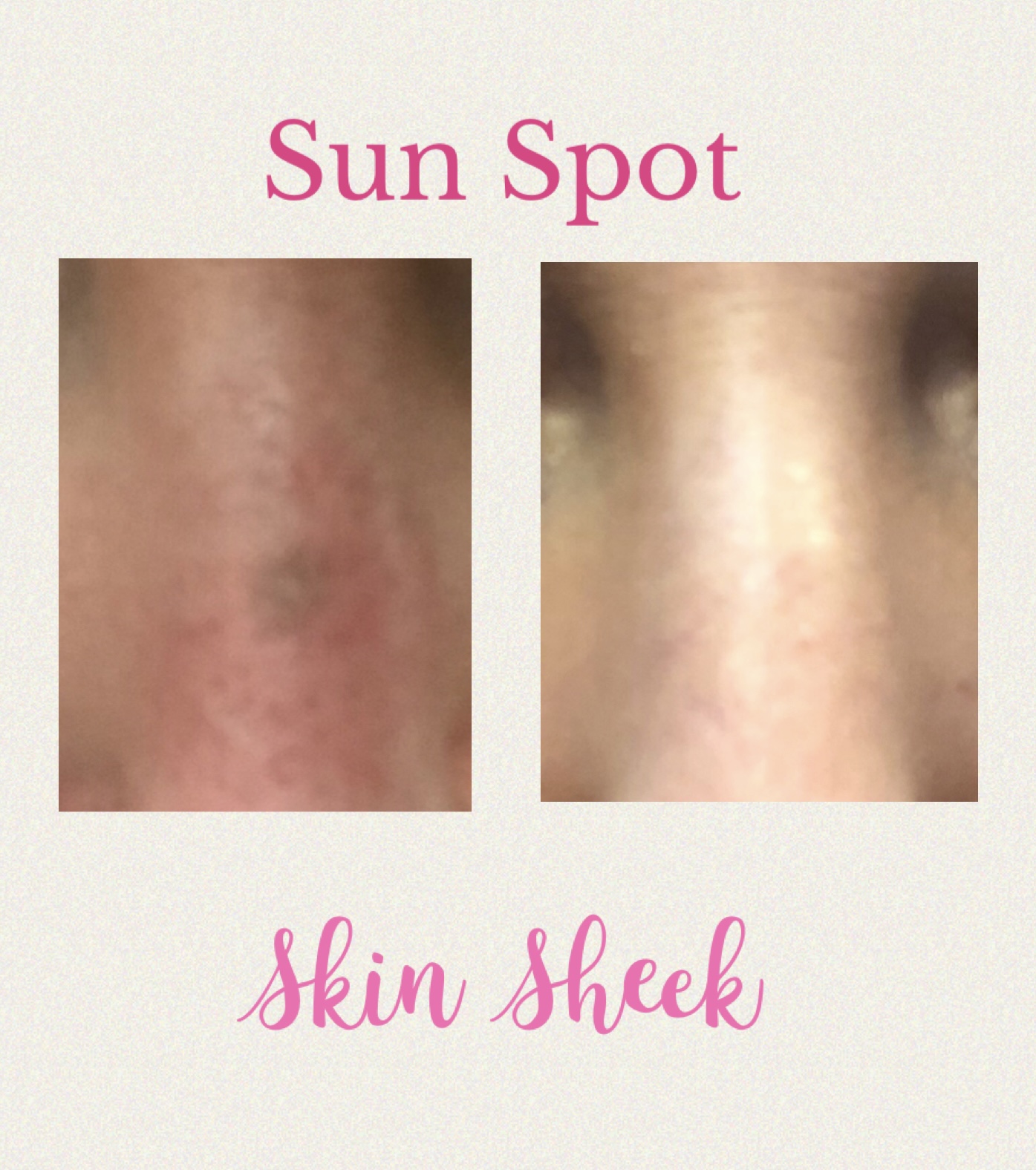 SUN SPOT ON NOSE BRIDGE-post 2 weeks