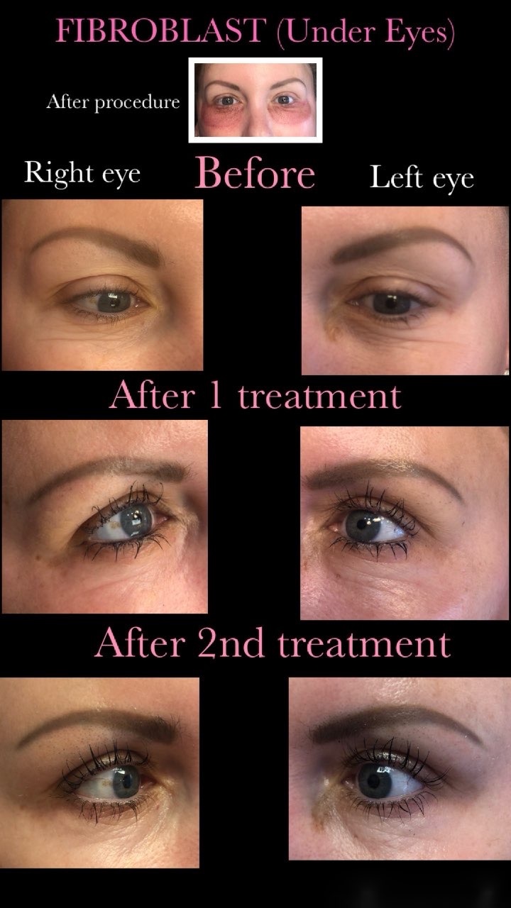 Plasma pen under eyes