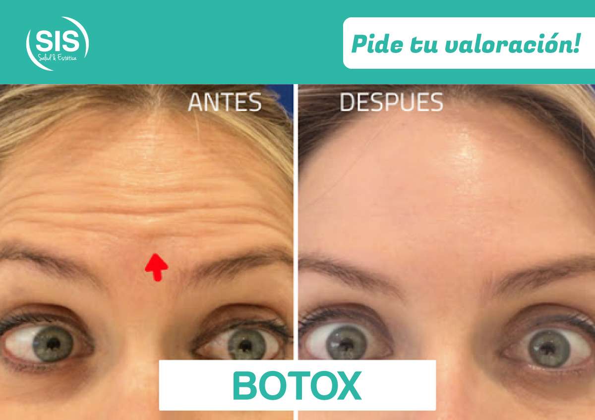 https://0201.nccdn.net/1_2/000/000/0fc/e94/BOTOX-1200x849.jpg