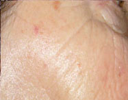 DESPUÉS (12 SESIONES)