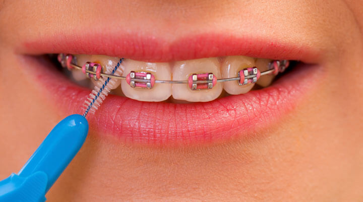 Orthodontic Dental Center - BRACKETS METALICOS