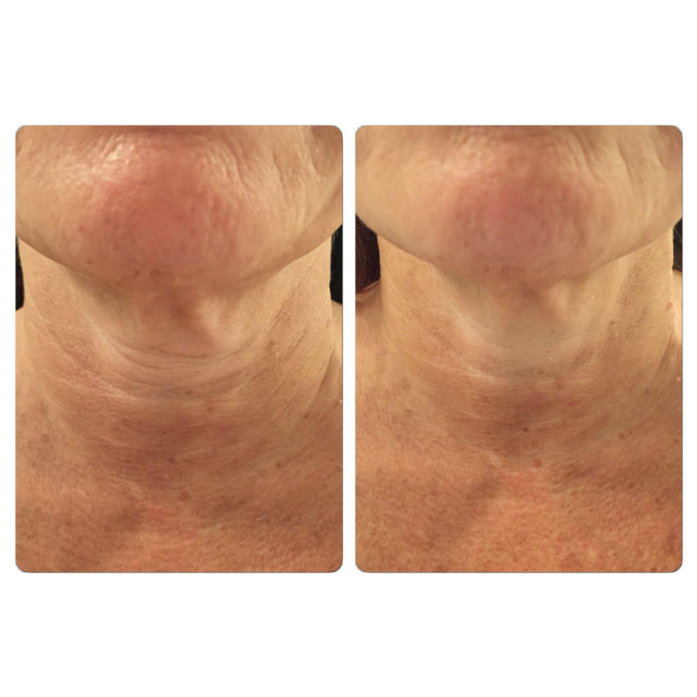Before & after six treatments