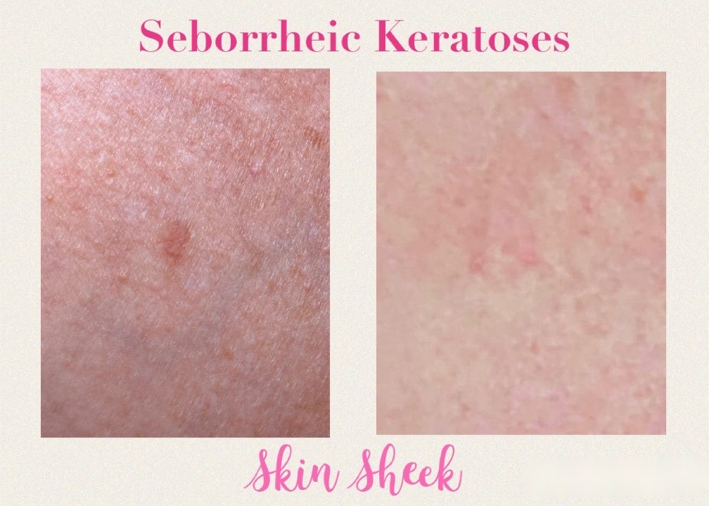 SEBORRHEIC KERATOSES
