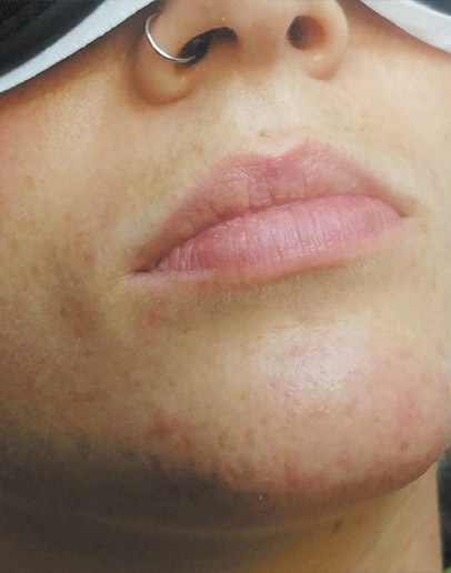 Chin Hair Removal (After)