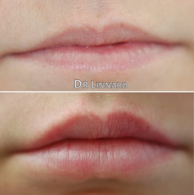 Lip Fillers: before and after
