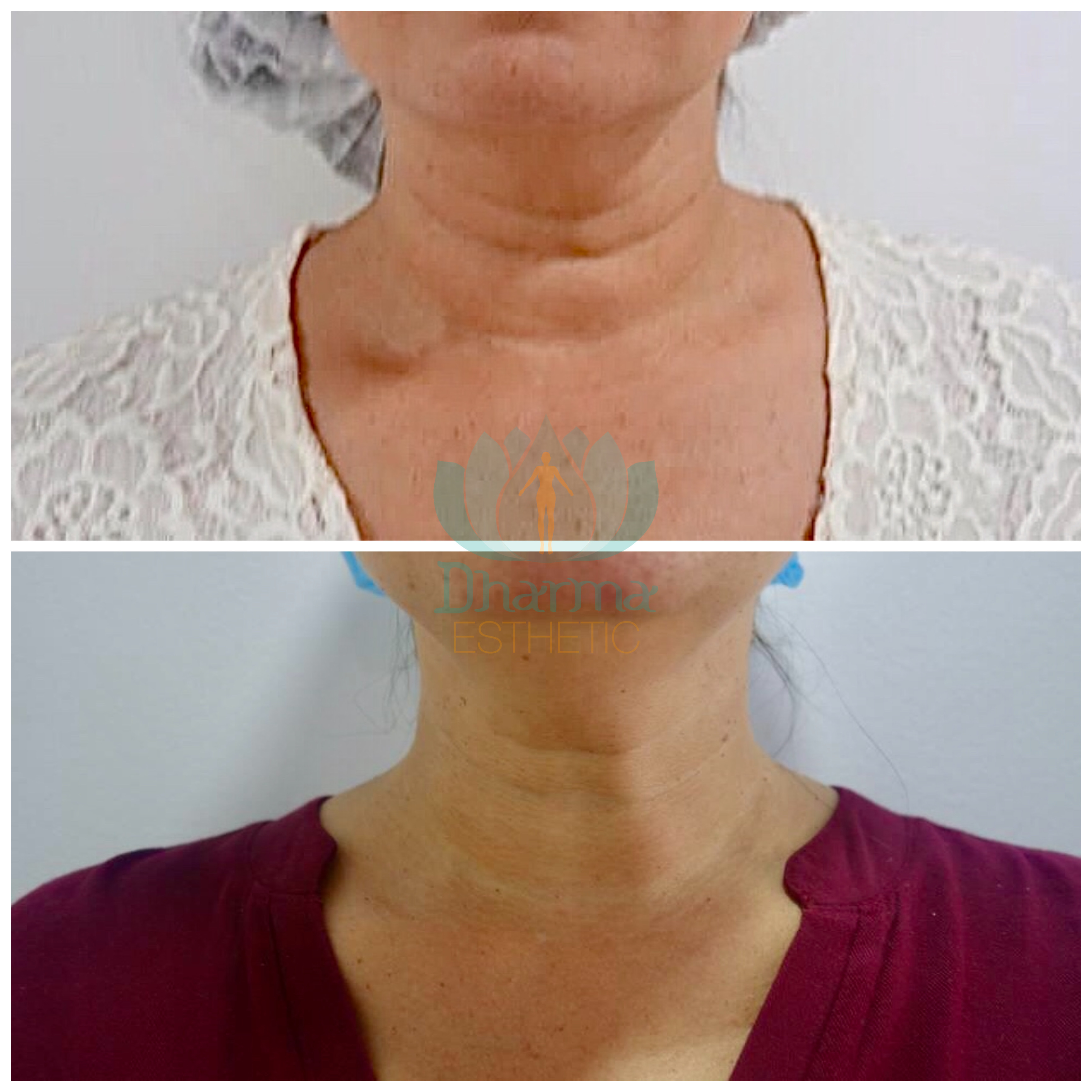 Reducción de papada