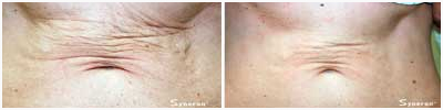 Sublime skin tightening reduces wrinkles and lines