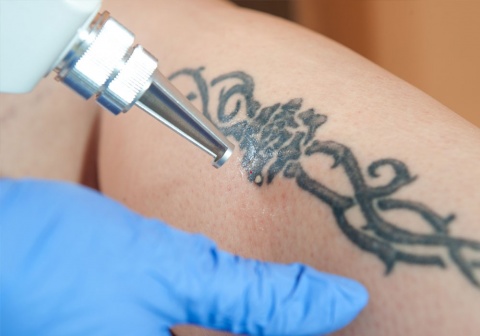 Yuma Tattoo Removal El Centro Dermatology