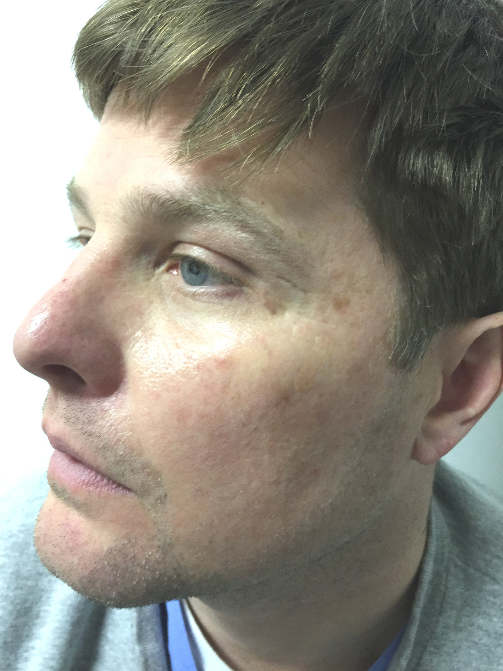 ||||<div style="text-align: left;">PA six months after he started to use the skin restore on and off</div>