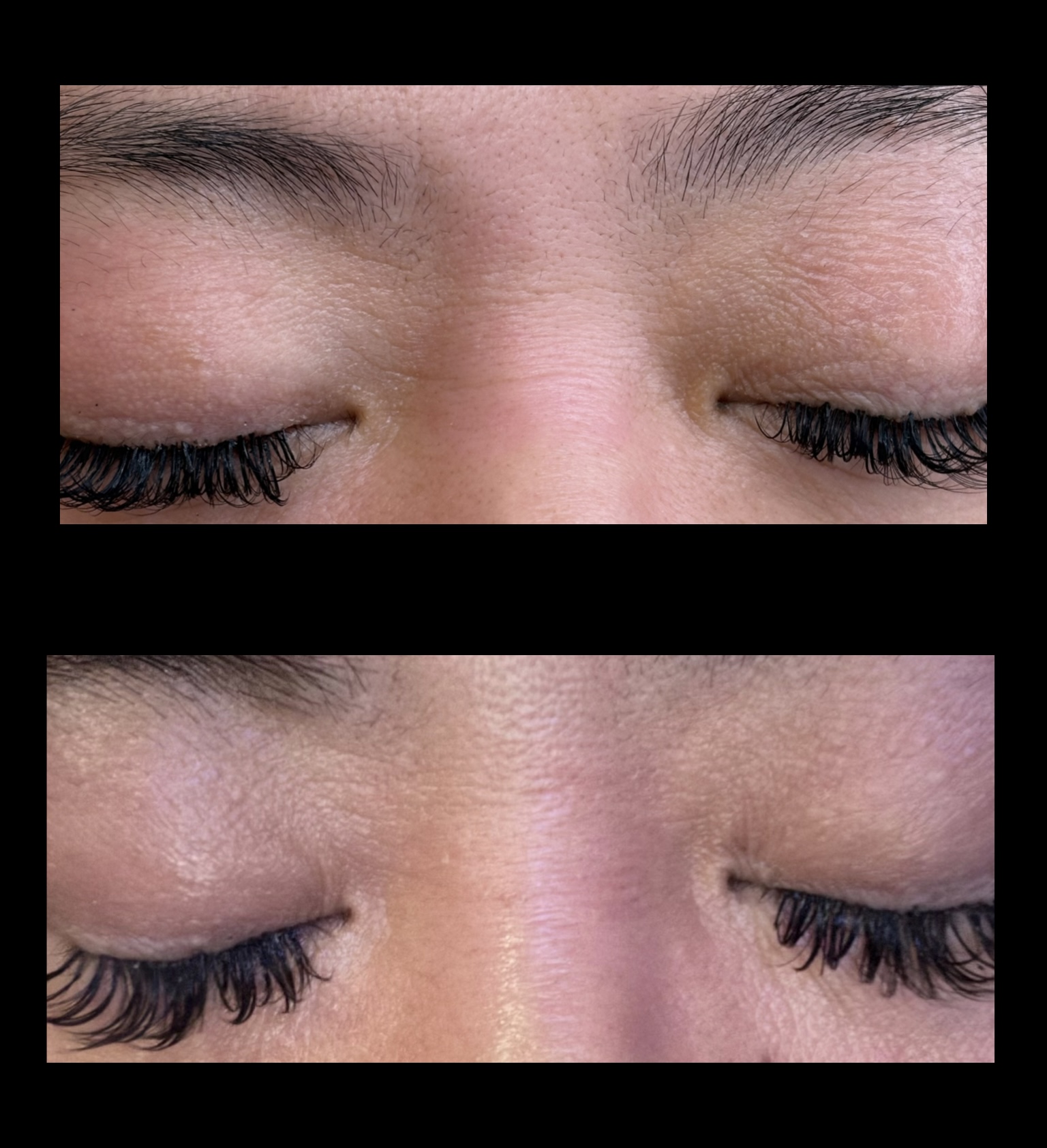 Nasal bridge - Bunny Lines