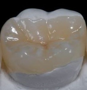 https://0201.nccdn.net/1_2/000/000/12a/dda/restauraciones-dentales-wa5og9xsqp4mbsjiy0yjnk.jpg