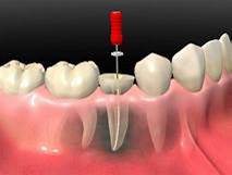 Endodoncia
