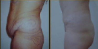 Before and After Treatment 2