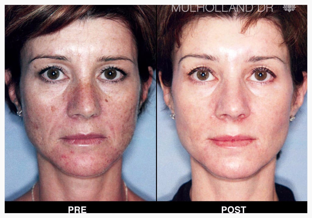 Before and after photos Laser Skin Tightening - Sublime wrinkle reduction and skin tightening
