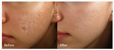 Before and after photos Laser Skin Rejuvenation - Sublative RF Rejuvenation treats Acne Scar reduction