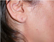 DESPUÉS (12 SESIONES)