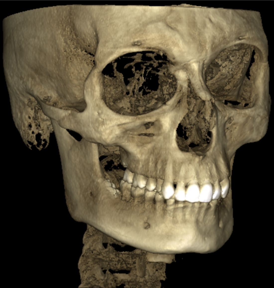 3D render of a human skull showing detailed bone structure and teeth