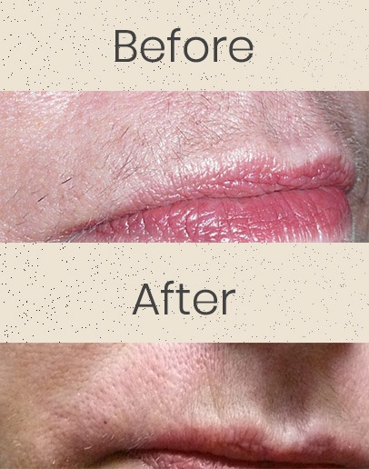 Lip Hair Removal (After), Lip Hair Removal (Before)