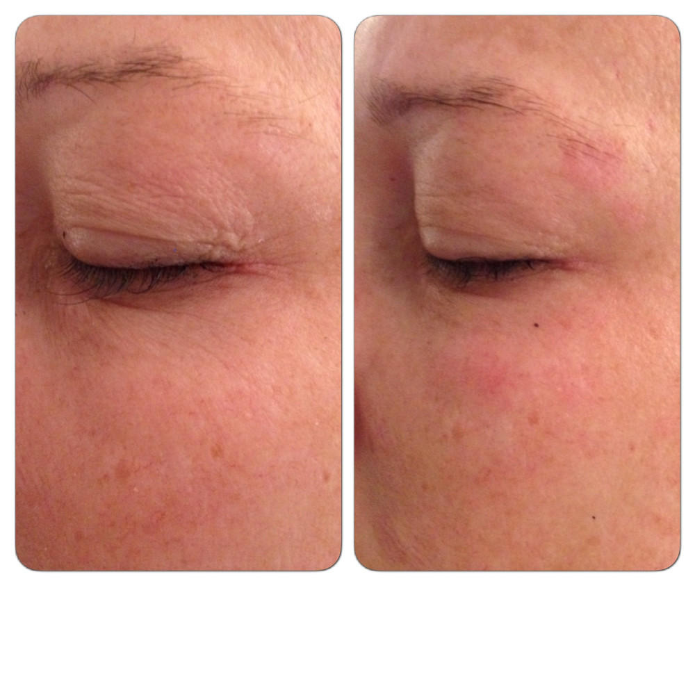 Before & after first treatment