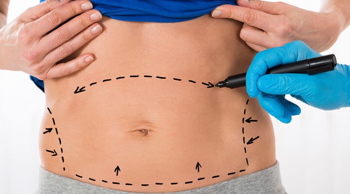 Dr Hermes Gonzalez Jimenez y Dra. Ma. Susana Fajardo - ABDOMINOPLASTIA