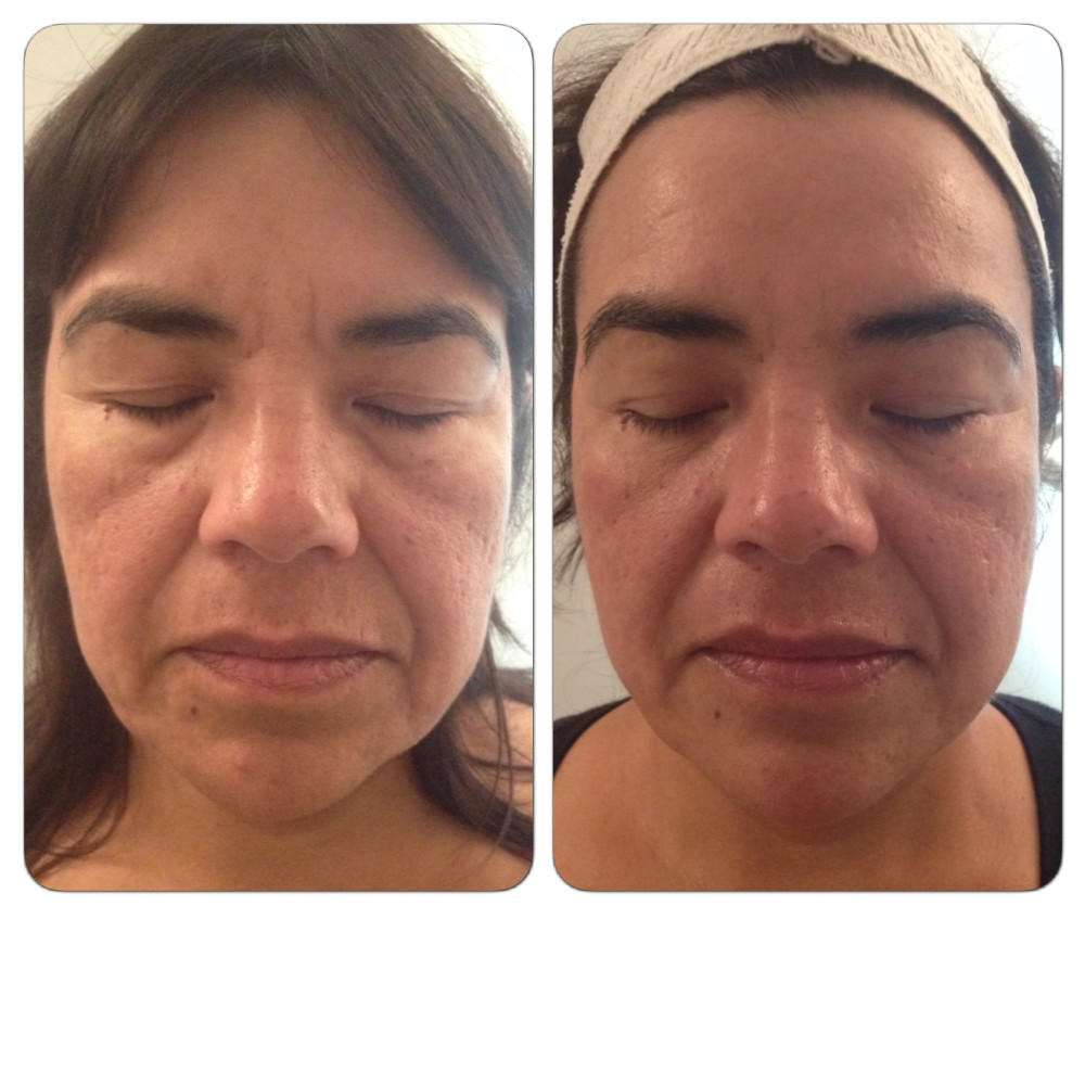 Before & after three treatments