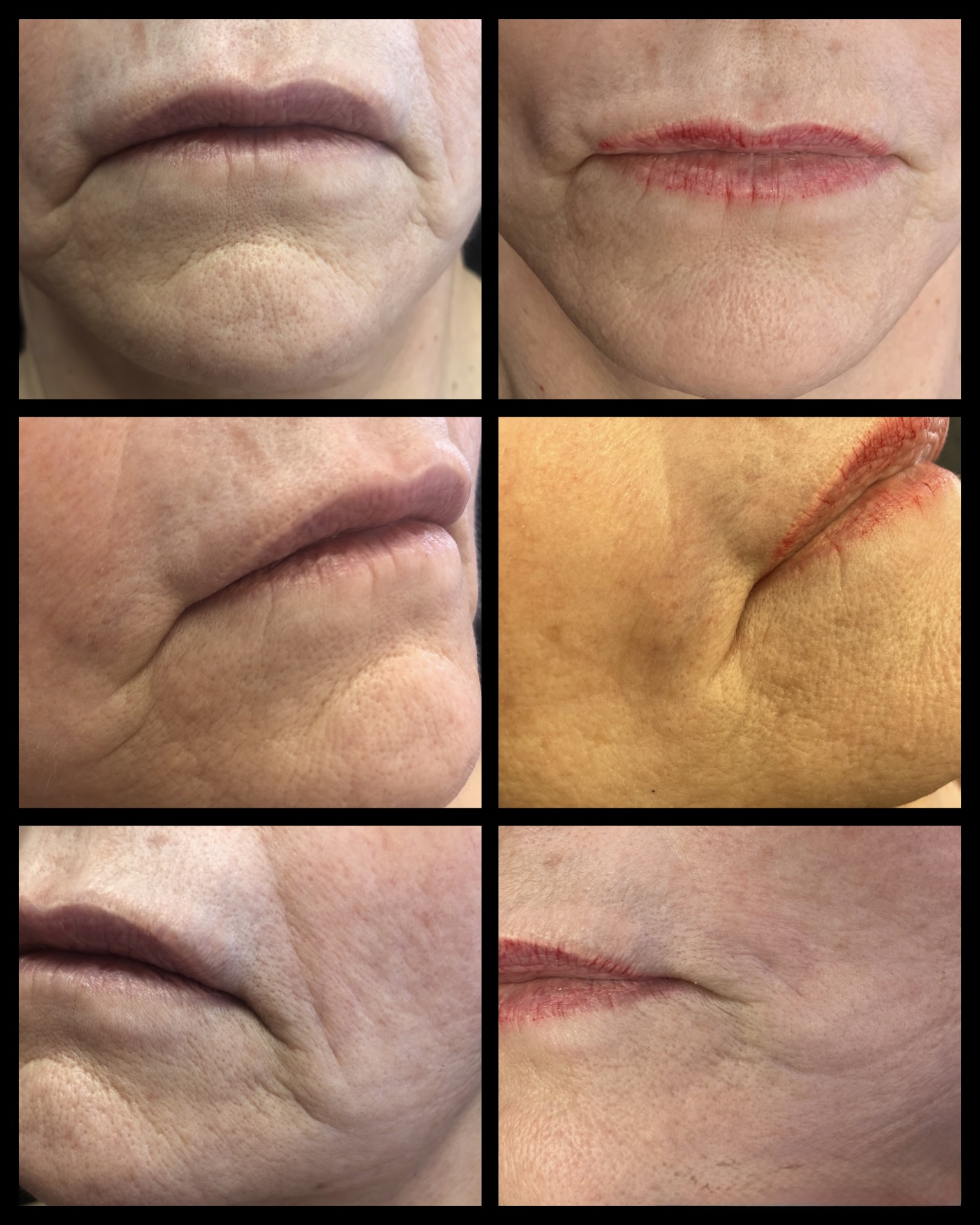 Plasma pen marionette / jowls