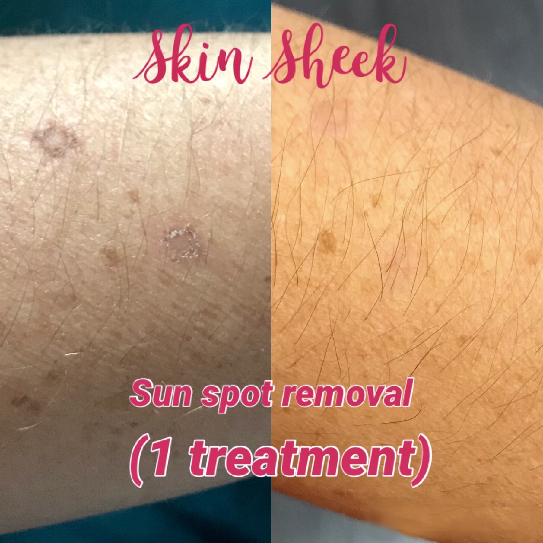 SUN DAMAGE -post 1 week