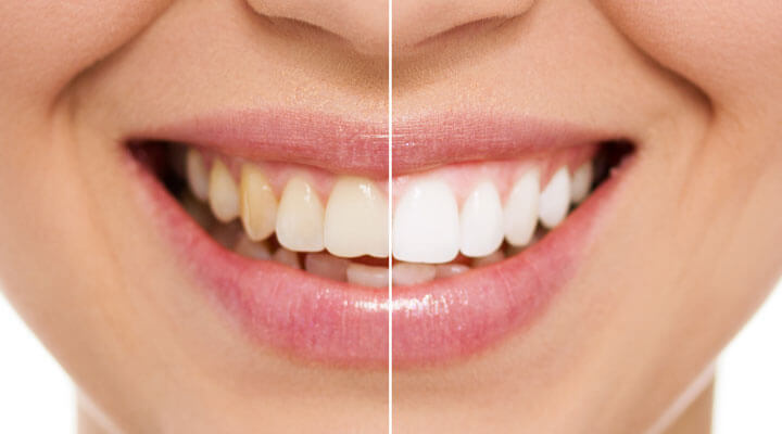 Micro Dental de San Miguel - BLANQUEAMIENTO