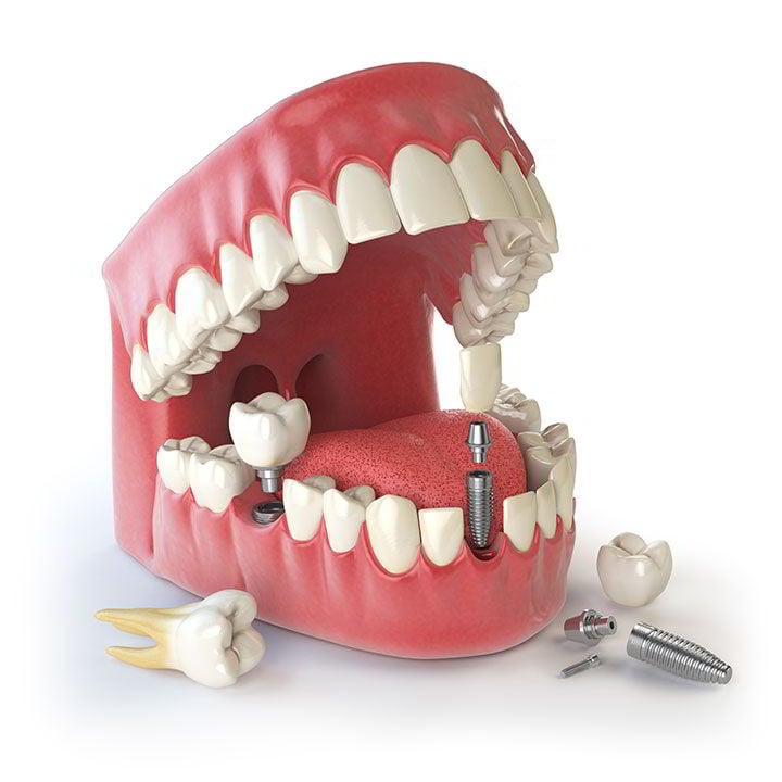 Laboratorio y Depósito Dental RH - Prótesis dentales